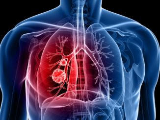 Deutlich mehr Menschen wegen Raucher-Krankheiten im Krankenhaus behandelt