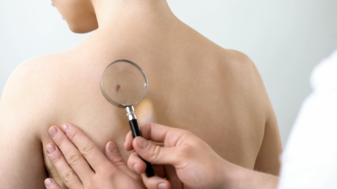 Symbolbild: Hautkrebs