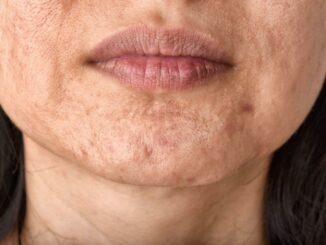 Erdbeerkinn behandeln: Welche Alternativen zu Botox gibt es?