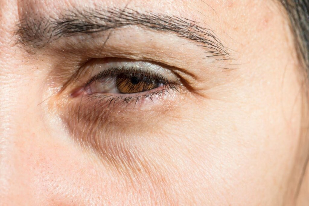 Dunkle Augenringe: Erkrankung der Schilddrüse als Ursache? 