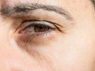 Dunkle Augenringe: Erkrankung der Schilddrüse als Ursache? 